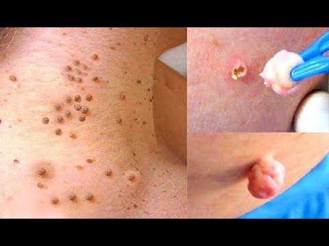 Since I have done this - I have no Skin Tags Goodbye to the Skin Tags Remove Skin Tags Easily