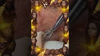 Blackheads Removal | Acne Treatment and Very Satisfying Satisfying Pimple pop #blackheads