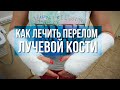 Как лечить перелом лучевой кости?