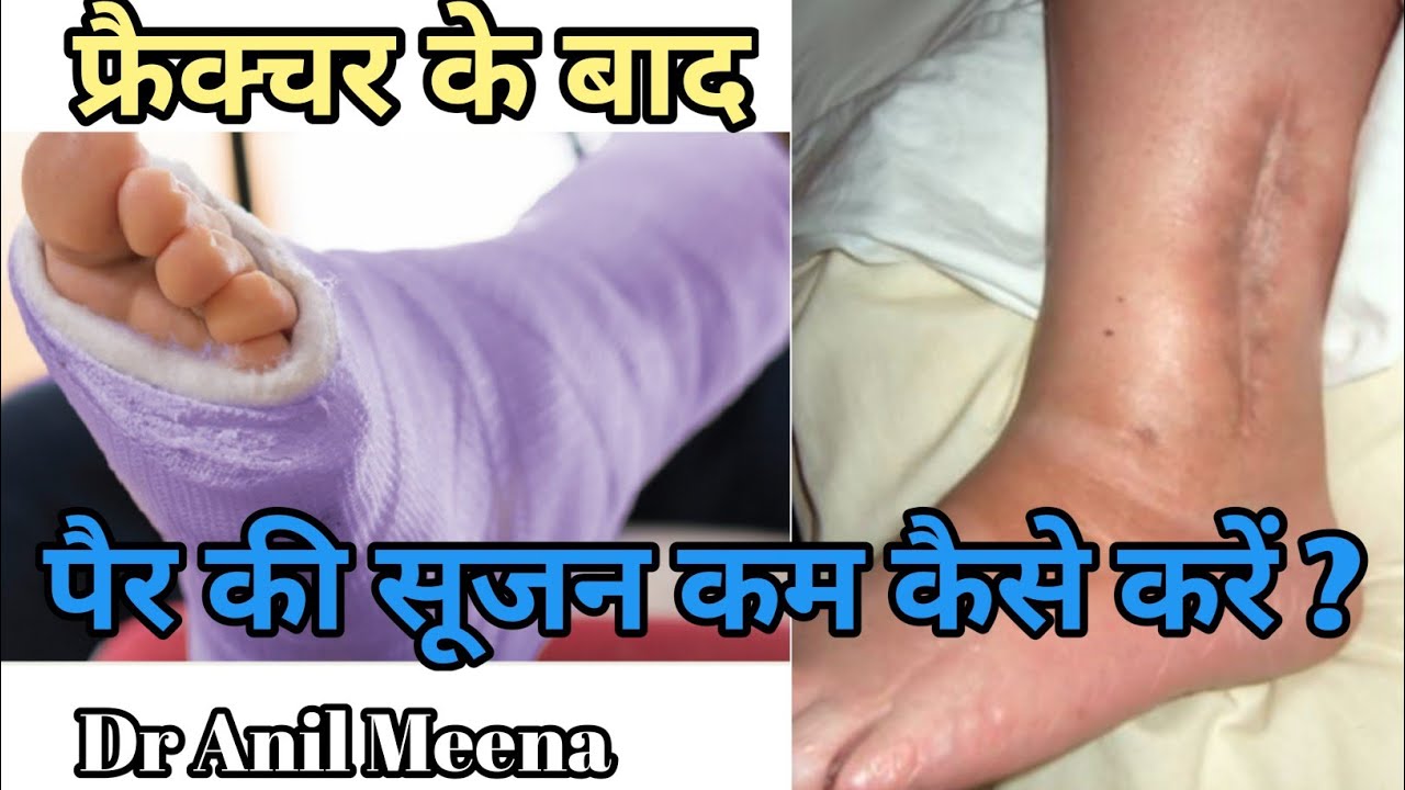 kcber  Update 2022  Foot Fracture Swelling Treatment | Leg Swelling Treatment | how to remote foot swelling | in hindi