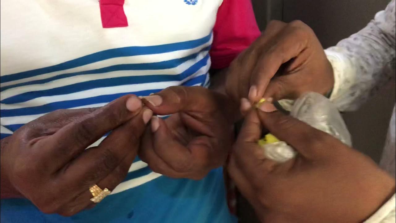 Asthma Fish treatment Hyderabad India YouTube