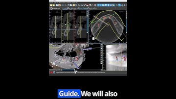 BSP5.0: Full Arch Surgical Guides Techniques #BlueSkyPlan #CTscan #surgicalguide #treatmentplan