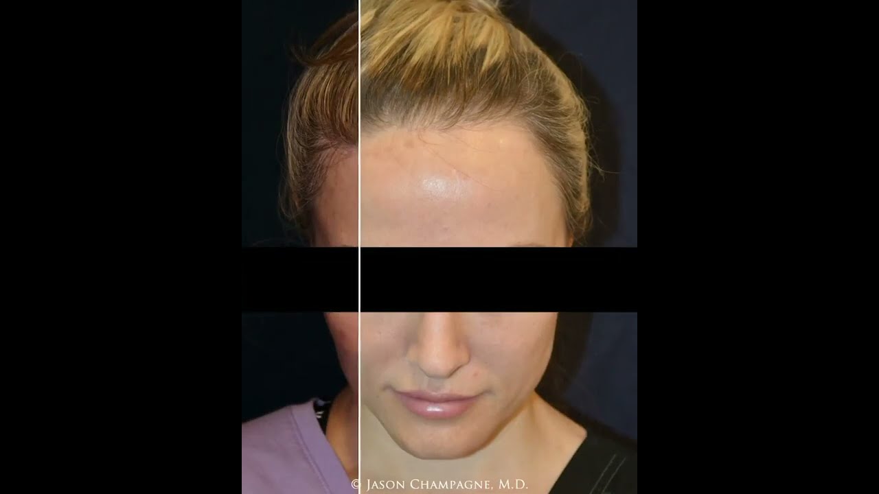 Dr. Champagne - Hairline Lowering Before & After