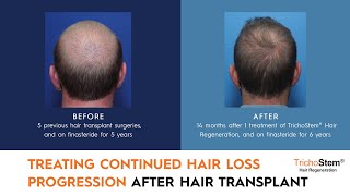 Why Treatment is Needed After Hair Transplants for Hair Loss Progression