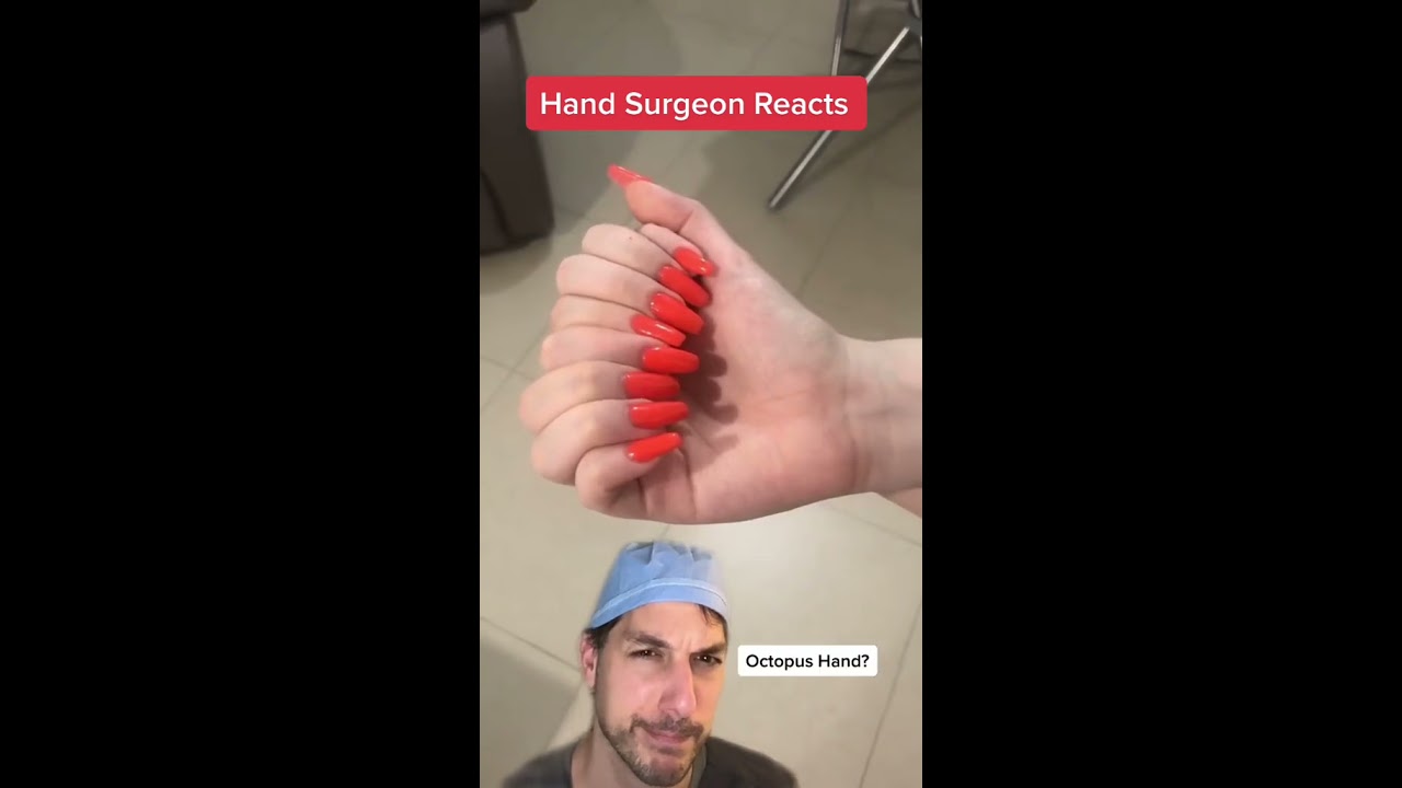 Too Many Fingers Polydactyly Hand Surgeon Dr Finger Health Medical