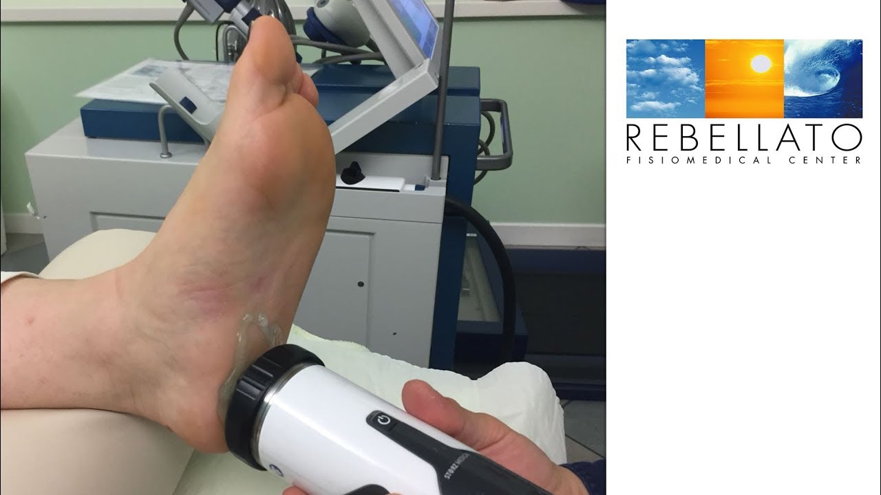 Tendinopatie, come trattarle con le Onde d’Urto