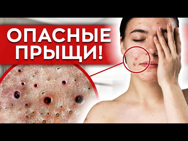 Давить ПРЫЩИ - ОПАСНО! / Как избавиться от прыщей? - YouTube