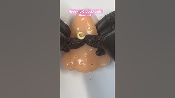 Let’s clean this nose extracting pimples #asmr #fypシ #viral #shorts