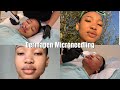 MICRONEEDLING BEFORE AND AFTER | MICRONEEDLING FOR ACNE | MY MICRONEEDLING EXPERIENCE