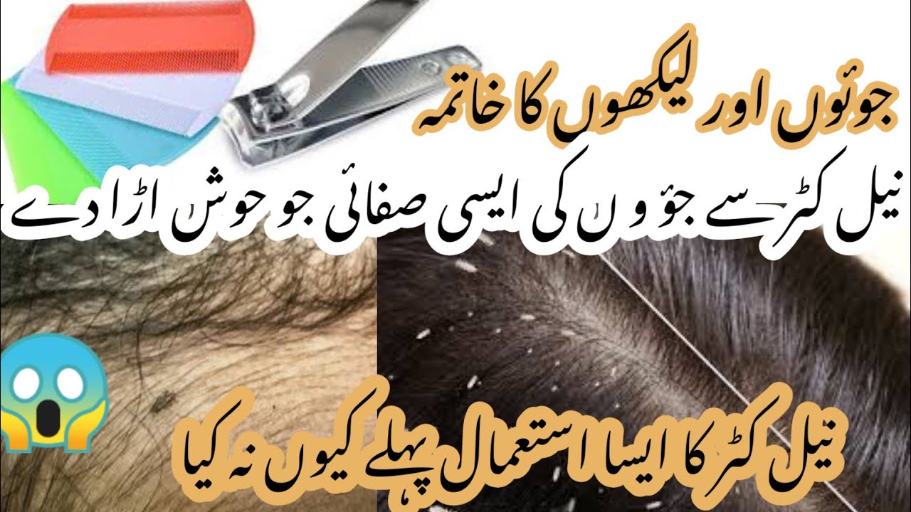 Juon or Likhon se Nijat   Anti Lice Treatment at Home  How to Get Rid of Head Lice