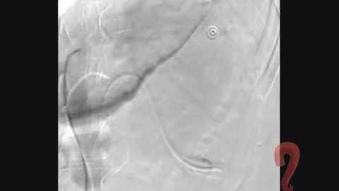 renal artery embolization post PCNL