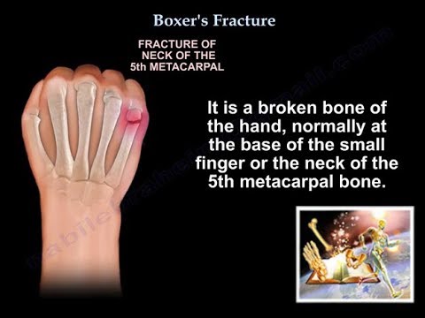 Boxer&rsquo;s Fracture - Everything You Need To Know - Dr. Nabil Ebraheim