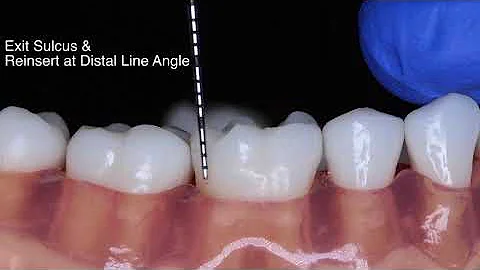 Periodontal Probe Basic Technique