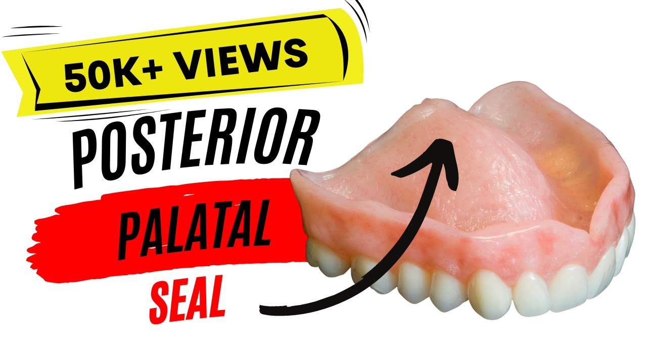 posterior palatal seal