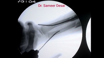 TENS ( titanium elastic nailing) for forearm fracture in children by Dr. Sameer Desai