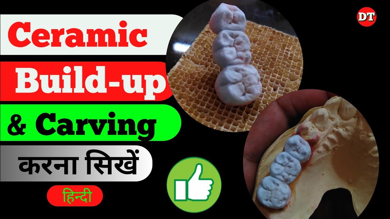3 unit build up Upper Dental Lab Work's Ceramic Build up video