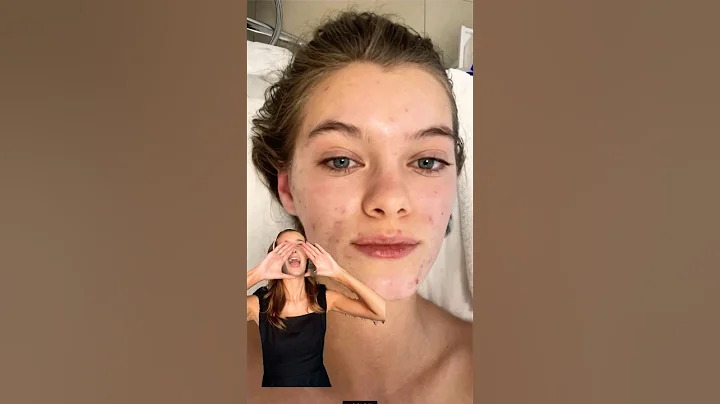 Never back down ACNE EDITION 😱🥹 #skincare #acne #acneproneskin #acnetreatment #skincareforacne