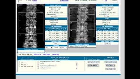 Quick Review and Report of DXA Bone Density test