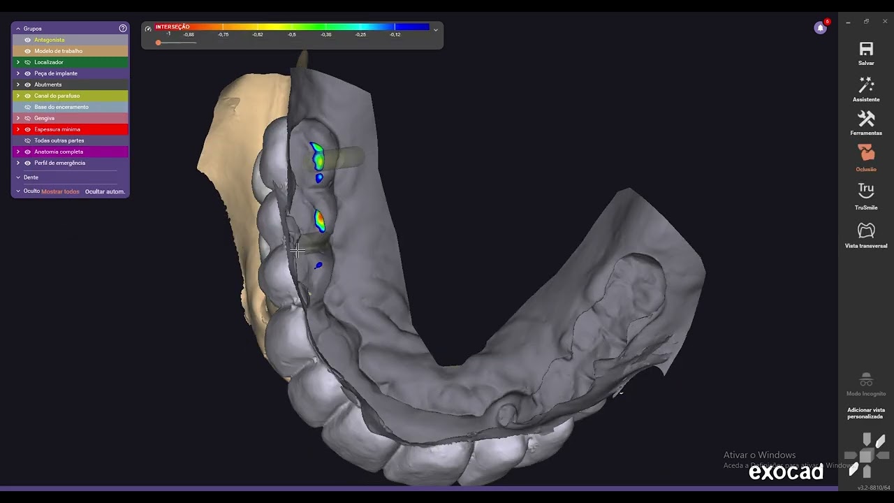 COMO FAZER COROA SOBRE IMPLANTE UNIDA NO EXOCAD | 2026 MÉTODO ATUALIZADO 