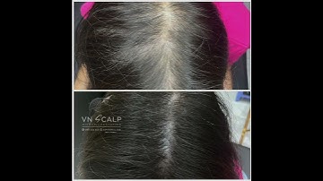 Xăm tóc đỉnh cao điêu khắc sợi như thật hàng đầu thế giới tại việt nam