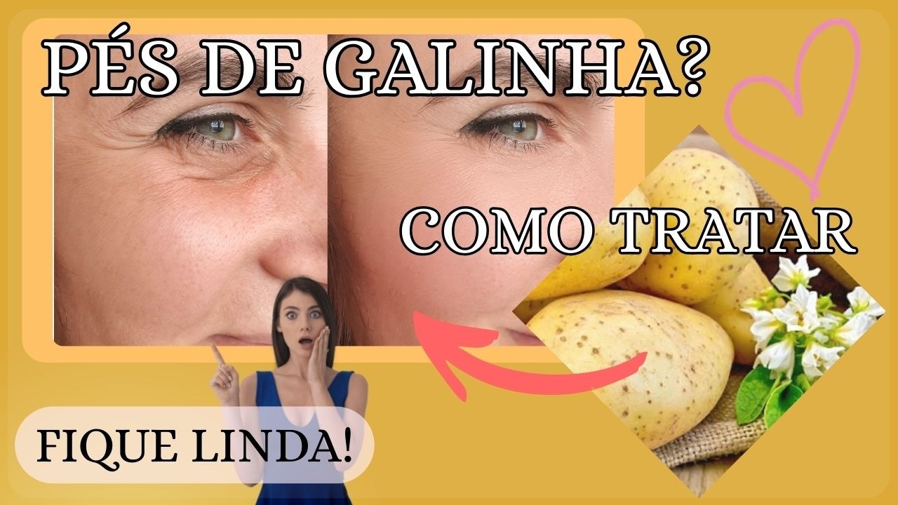 PÉS DE GALINHA? VEJA AGORA COMO AMENIZAR ESSE PROBLEMA COM ESSAS DICAS!