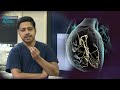 A journey to relief dr karthigesans exploration of cryoballoon  rf ablation for afib