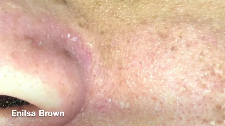 Acne Extractions/ Daryl Part 2