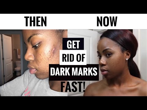 NIGHT SKINCARE ROUTINE| How I Got Rid of Acne Scars &Dark Marks