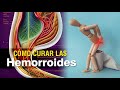 Cómo curar las hemorroides