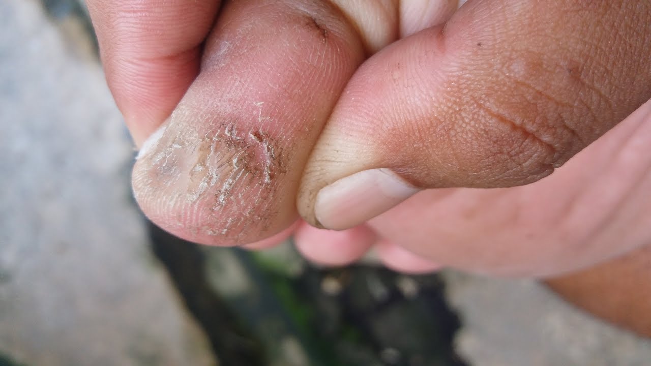 Cara menghilangkan sel kulit mati di jempol kaki