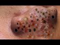 Extreme Blackhead Removal at LNG Skin Care # 65231