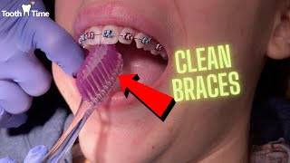 Como manter meu aparelho limpo Ferramentas para limpeza de aparelho Como escovar