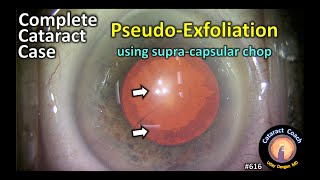 complete cataract case: pseudo-exfoliation and supra-capsular chop
