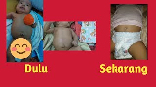 Cara Mengatasi Pusar Bayi Bodong Atau Menonjol Keluar, 100% Berhasil Pengalaman Pribadi