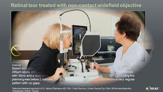 Laser retinopexy: Non-contact navigated laser treatment of a retinal tear with Navilas® 577s