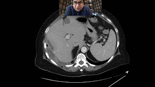 Dropped gallstones with abscess