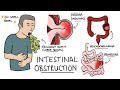 Intestinal Obstruction - Small Bowel Obstruction vs Large Bowel Obstruction