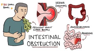 Intestinal Obstruction  Small Bowel Obstruction vs Large Bowel Obstruction