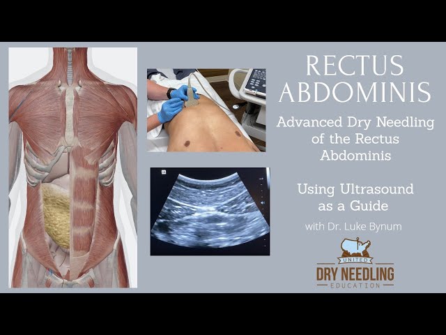 Dry needling / Ultrasound dry needling