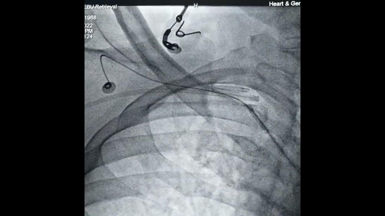 Guiding catheter (EBU) entrapped in right subclavian artery YouTube