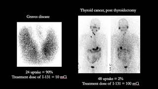 Radio-Iodine Treatment: Graves Disease vs Thyroid Cancer.