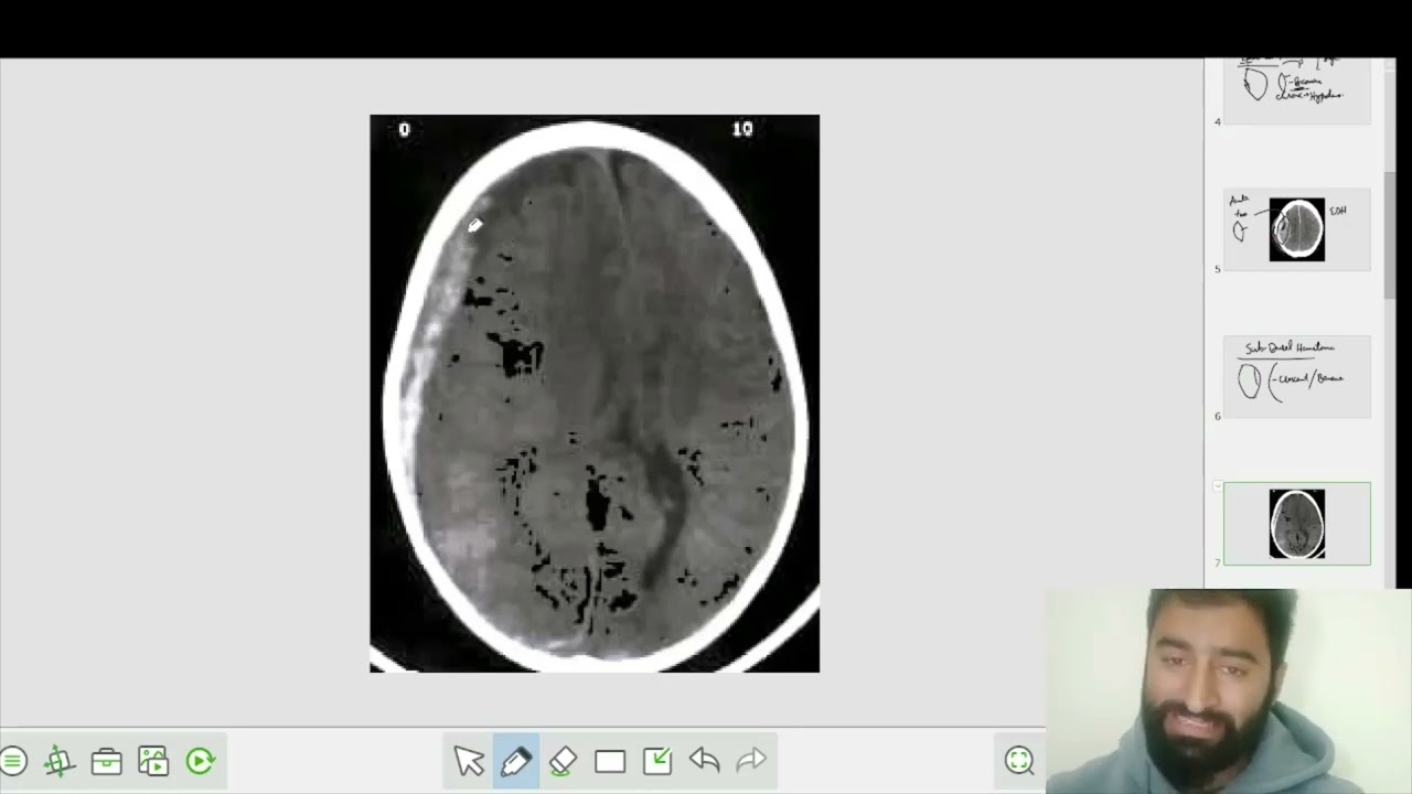 CT Head interpretation ||Brain Pathology||