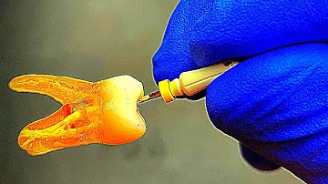 Root Canal Working Length Part 2 (Endodontist