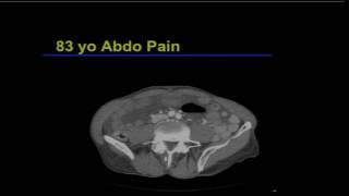 Abdominal Imaging:  Acute Bowel Disease – Benjamin Yeh, MD