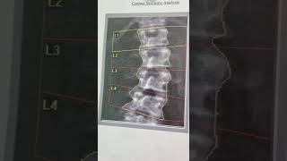 radiology   radiographer    shorts   اشعه هشاشة العظام وما يسبب الهشاشة
