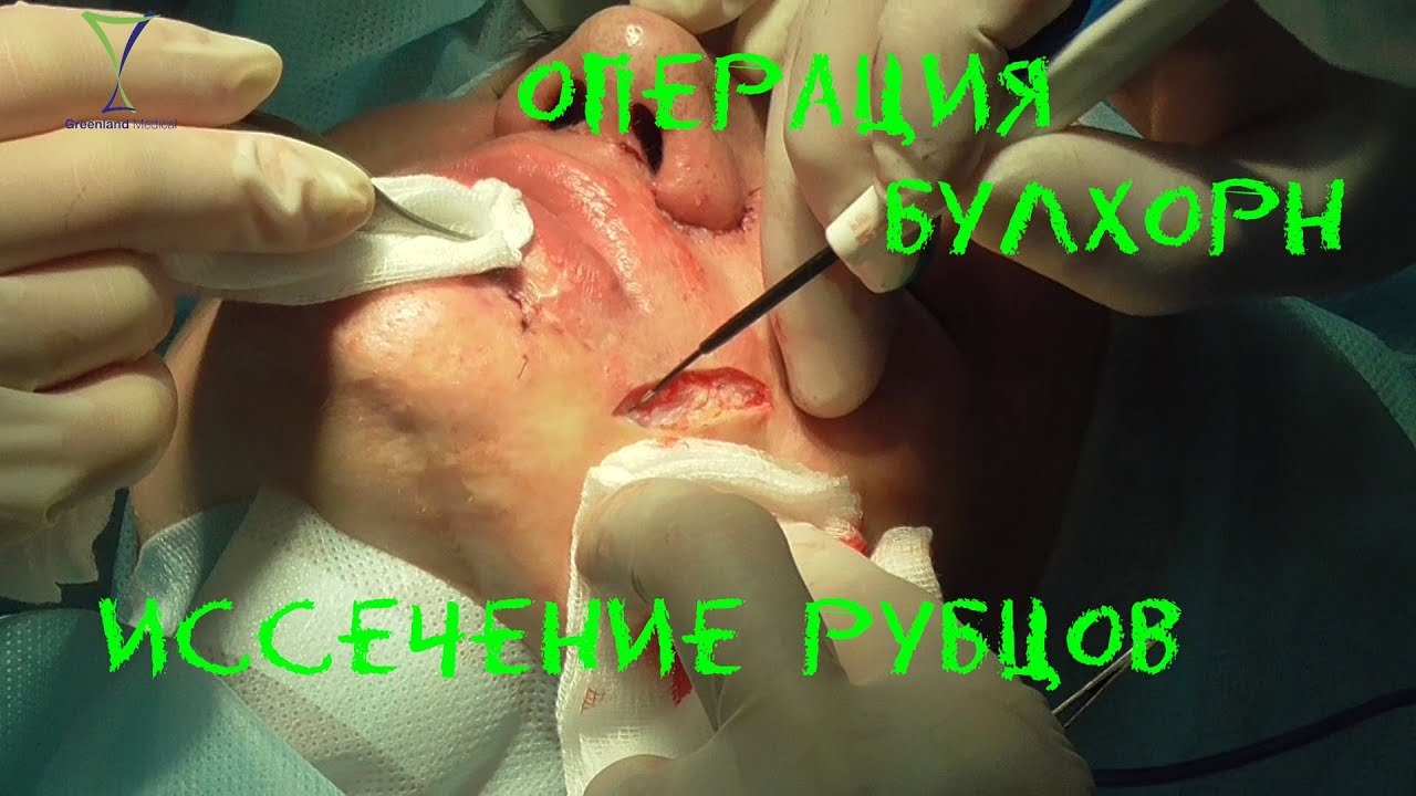 Операция Булхорн и иссечение рубцов на радиоволновом аппарате Greenland Medical