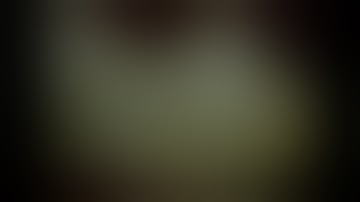 Laparoscopic Appendectomy Inflammed and Gangrenous Appendicitis