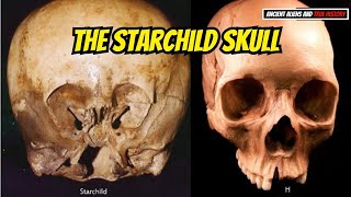 The Starchild Skull – A Discovery Of Alien Ancestors