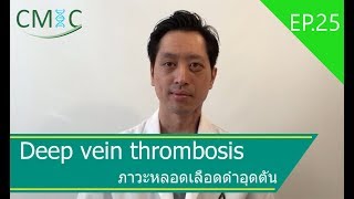 ภาวะหลอดเลือดดำอุดตัน(DVT)และความเสี่ยงของโรคลิ่มเลือดอุดกั้นในปอด(PE)โดยนายแพทย์จักรีวัชร