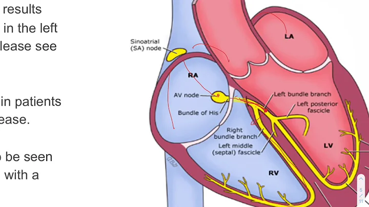 ECG of the Week- Left Bundle Branch Block